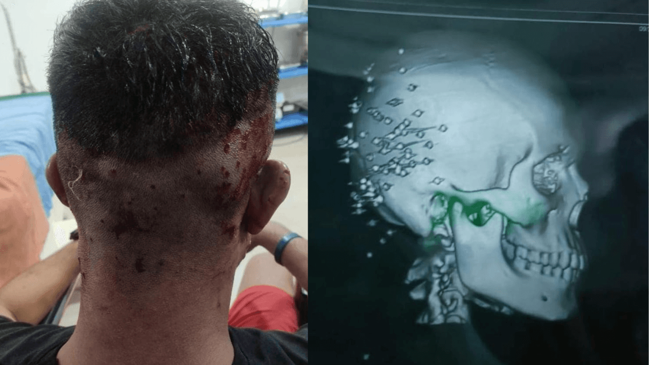 “I am injured but not scared” told the 17 year old boy with more than 58 ‘pellet’ needles pierced into his skull and now undergoing surgery, allegedly fired by RAF during protest in Imphal, Manipur