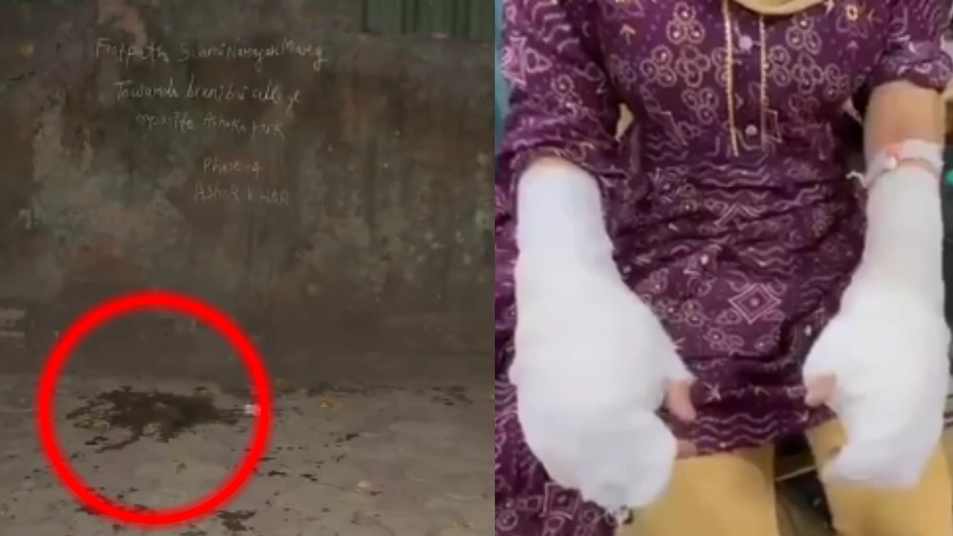 Delhi University Student Attacked with Acid near College; NCW takes Suo-Motu Cognisance